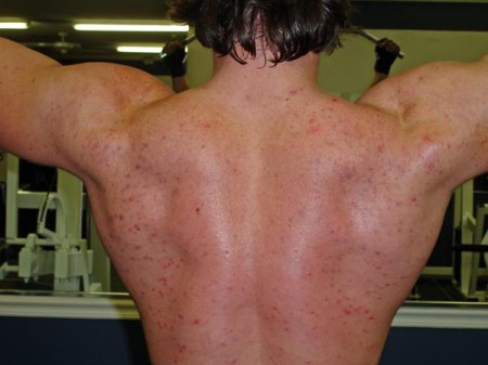 Anabolic steroid skin rash